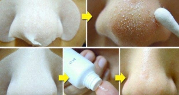 Here is a natural trick to permanently eliminate blackheads