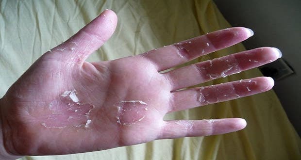 3 Astuces Naturelles Pour Lutter Contre Les Mains Qui Pelent